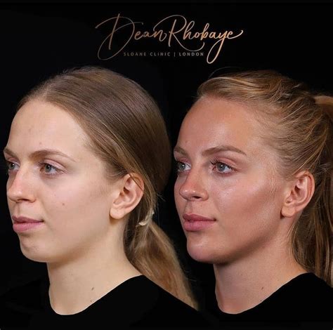 Facial Transformations: Surgical vs. Non-Surgical Methods