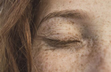 Factors Influencing the Formation of Freckles