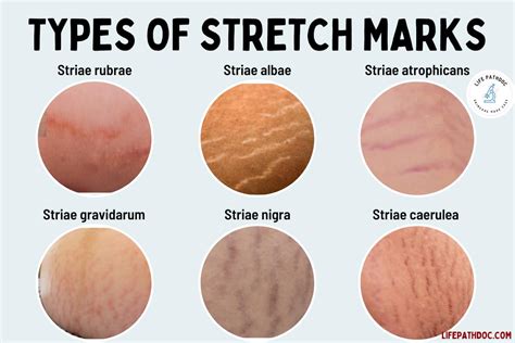 Factors that Influence the Development of Stretch Marks