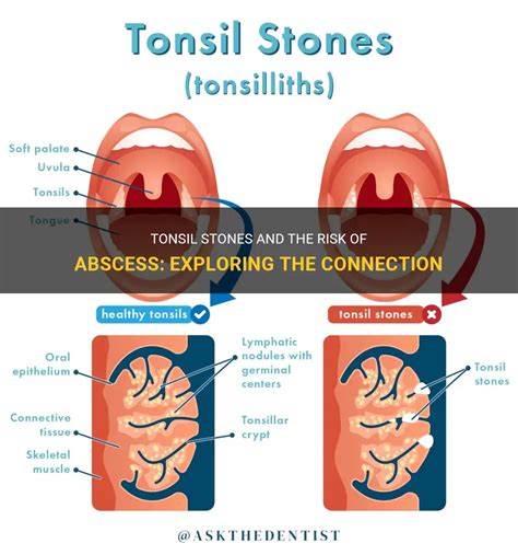 Fear of Losing Communication: Exploring the Connection to Tonsils