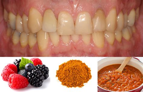 Foods and Drinks to Avoid for a Stain-Free Smile