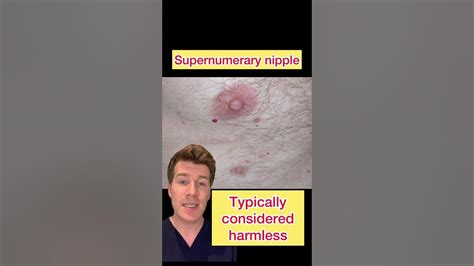 From Astonishing to Potential Health Concern: The Significance of a Supernumerary Nipple