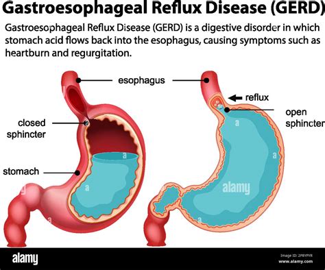 Gastroesophageal Reflux Disease (GERD): An Unexpected Association with Phlegm-Related Choking