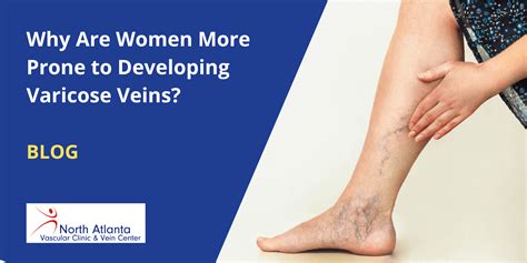 Gender Matters: Why Women Are More Prone to Spider Veins