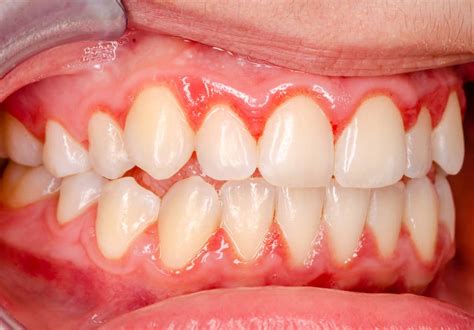 Gingivitis: The Initial Stage of Gum Disease and How to Manage It