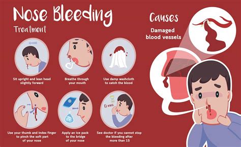 Health Implications: Is the Occurrence of Nasal Hemorrhages in Dreams a Reflection of Underlying Medical Concerns?