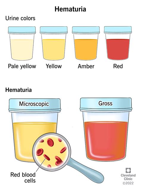 Hematuria: When Urine Appears Red, It Could Indicate an Underlying Health Condition