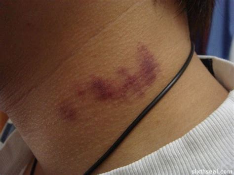 Hickey as a Symbol of Passion: Understanding the Fetishization of Love Bites