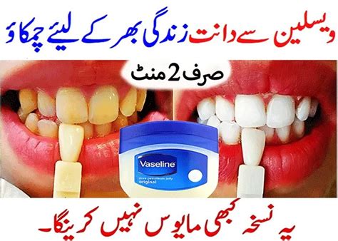 Home Remedies to Attain a Dazzling Smile