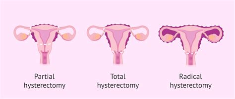 Hope and Guidance: Inspiring Stories of Women Who Achieved Conception Following a Hysterectomy