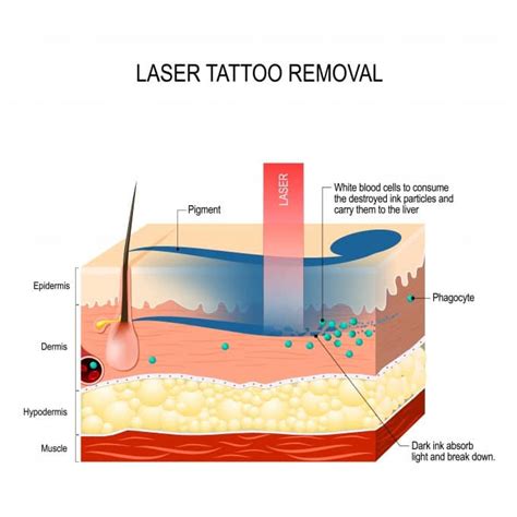 How Does Laser Tattoo Removal Work?