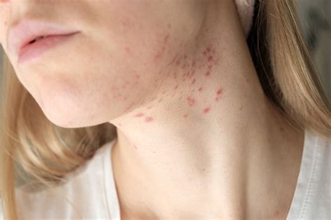 How Neglected Hygiene Can Induce Breakouts on the Neck