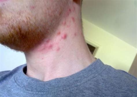 Identifying Allergic Reactions as a Potential Cause of Neck Blemishes