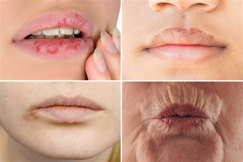 Identifying the Symptoms of Oral Herpes: Signs and Warning Signs