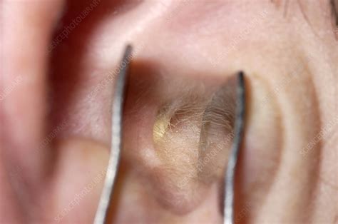 Ignoring the Presence of a Foreign Object in the Ear: A Risky Decision with Potential Complications