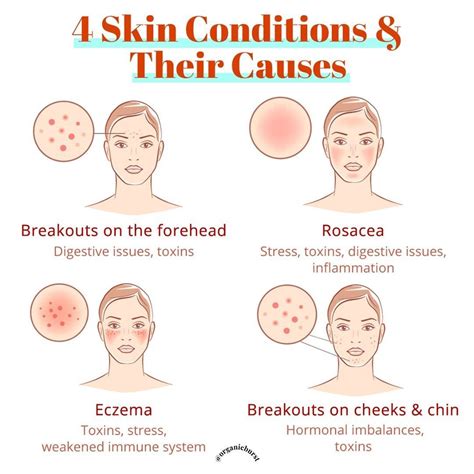 Impact of Hormonal Imbalance on Skin Breakouts