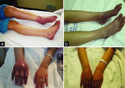 Injuries and Trauma: A Possible Cause of Enlarged Limbs