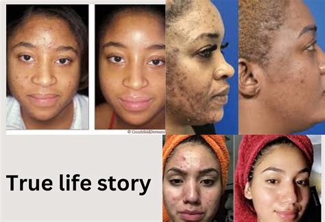 Inspiring Stories of Overcoming Enormous Pimples