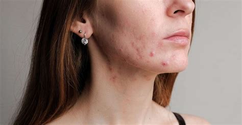 Interpretations and Beliefs Regarding Dream Pimples