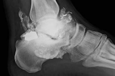 Interpreting the Location of the Gunshot Injury: The Significance of the Ankle