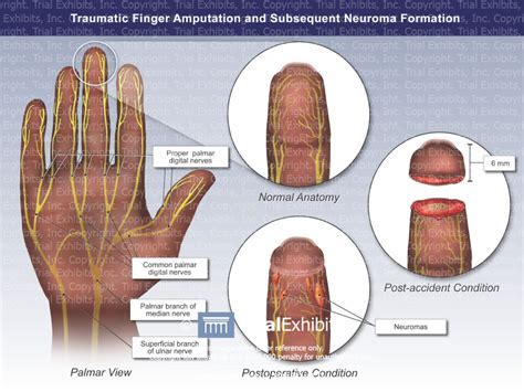 Interpreting the Significance of Hand Amputation in Dream Psychology