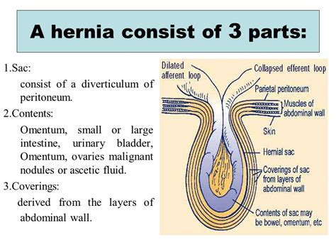 Intriguing Insights into the Formation of a Hernia