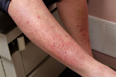 Investigating the Link Between Arm Rashes and Immune System Conditions