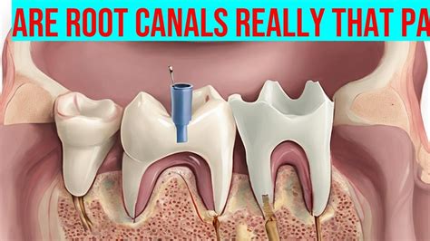 Is Root Canal Painful? Debunking the Myths and Exploring Pain Management Options