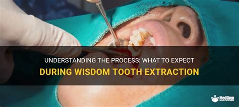 Knowing What to Anticipate during Wisdom Teeth Surgery