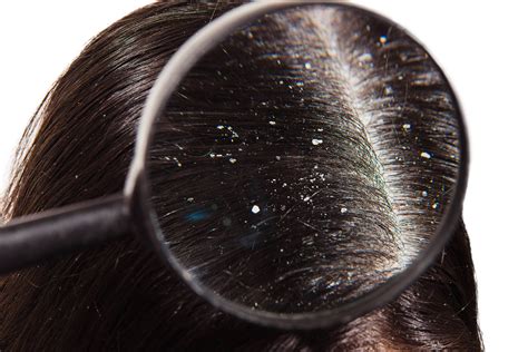 Knowing When to Seek Medical Assistance for Severe Dandruff: Available Treatment Options