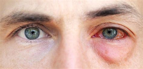 Knowing When to Seek Medical Attention for Eye Discharge