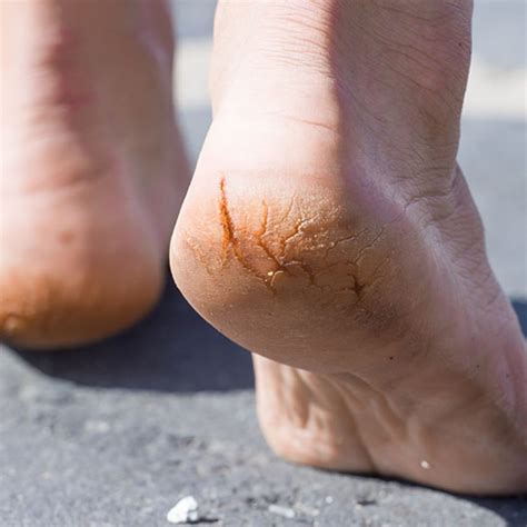 Knowing When to Seek Professional Help for Severe Cracked Heels