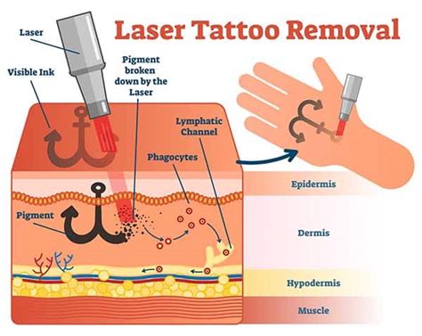 Laser Tattoo Removal: Understanding the Process for Future Regret