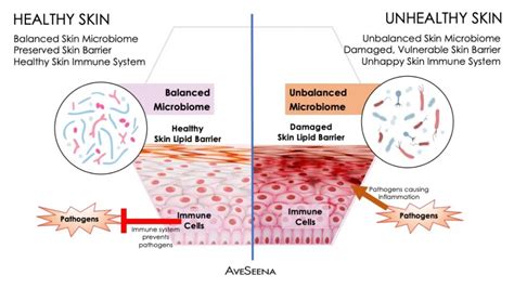 Lifestyle Factors and their Influence on Skin Health and Acne