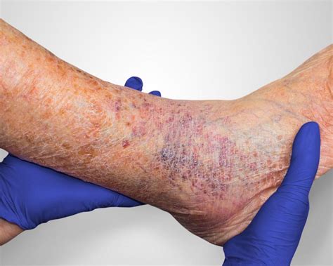 Living with Leg Ulcers: Managing Pain and Discomfort