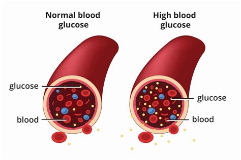 Long-Term Effects: The Perils of Uncontrolled Elevated Glucose Levels