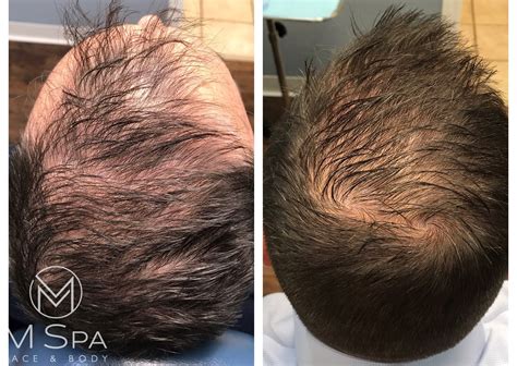 Long-Term Results: Maintaining and Caring for Restored Hair