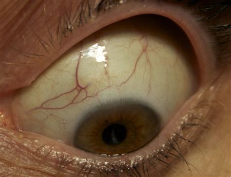 Looking Ahead: Progress in Detecting and Treating Eye Worms