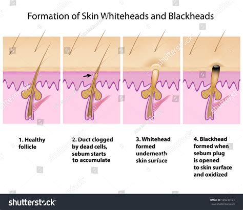 Maintaining Healthy Skin and Minimizing Blackhead Formation