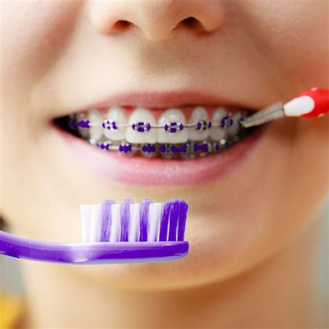 Maintaining Oral Hygiene and Proper Care for Orthodontic Appliances