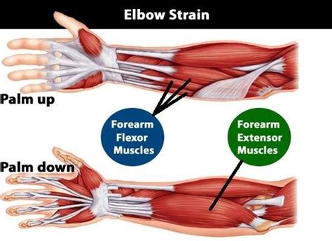 Mastering the Art: Preventing Elbow Strain and Overuse