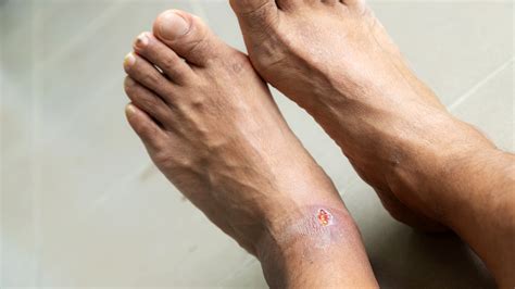 Methods for Decoding Dreams of Unhealed Sores on the Foot