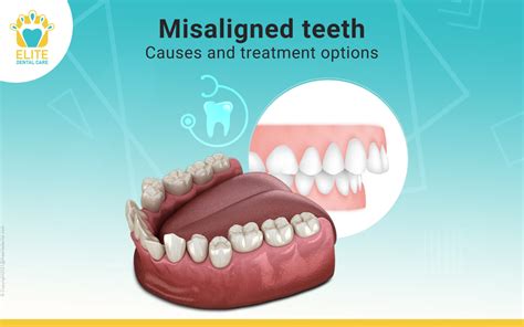 Misalignment of the Teeth: A Possible Culprit