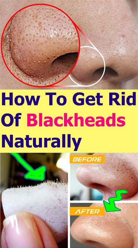 Mistakes to Avoid When Getting Rid of Blackheads