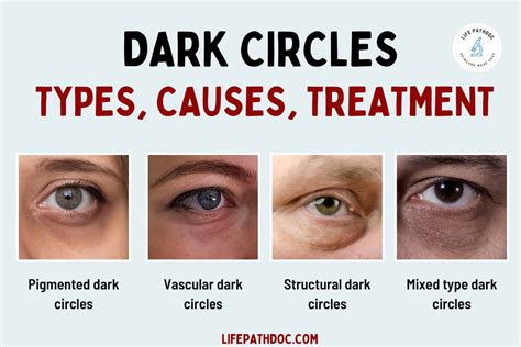 Misunderstandings and Falsehoods Regarding the Enigmatic Symbolism Associated with Dark Circles under the Eyes during Dream Analysis