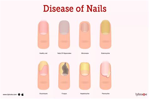 Nail Health and Safety: Preventing Common Nail Issues