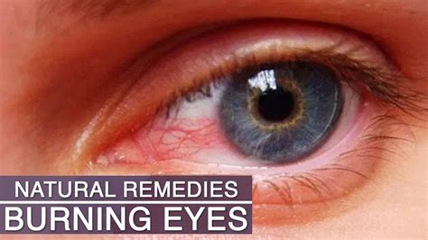 Natural Remedies for Soothing and Refreshing Fatigued Eyelids