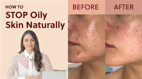 Natural Ways to Combat Excessively Oily Skin: Tried and Proven