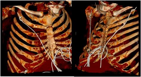 Nightmares or Warnings? Unveiling the Potential Cautionary Messages Linked to Dreaming of a Fractured Thorax