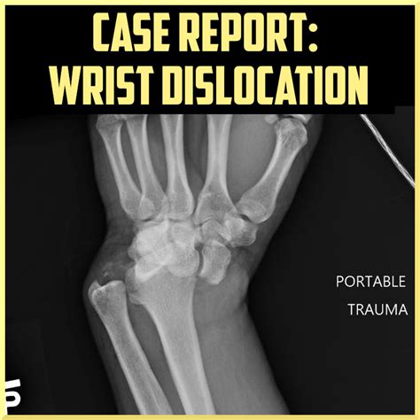 Nonsurgical Treatment Options for Wrist Dislocation